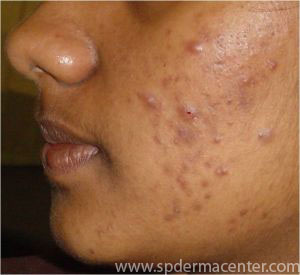PIH-Acne-Before